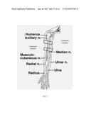 Methods and Systems for Treatment of Spasticity diagram and image