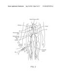 Direct Heat Ablation Catheter diagram and image