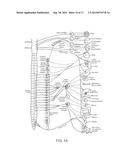 Direct Heat Ablation Catheter diagram and image