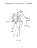 Direct Heat Ablation Catheter diagram and image