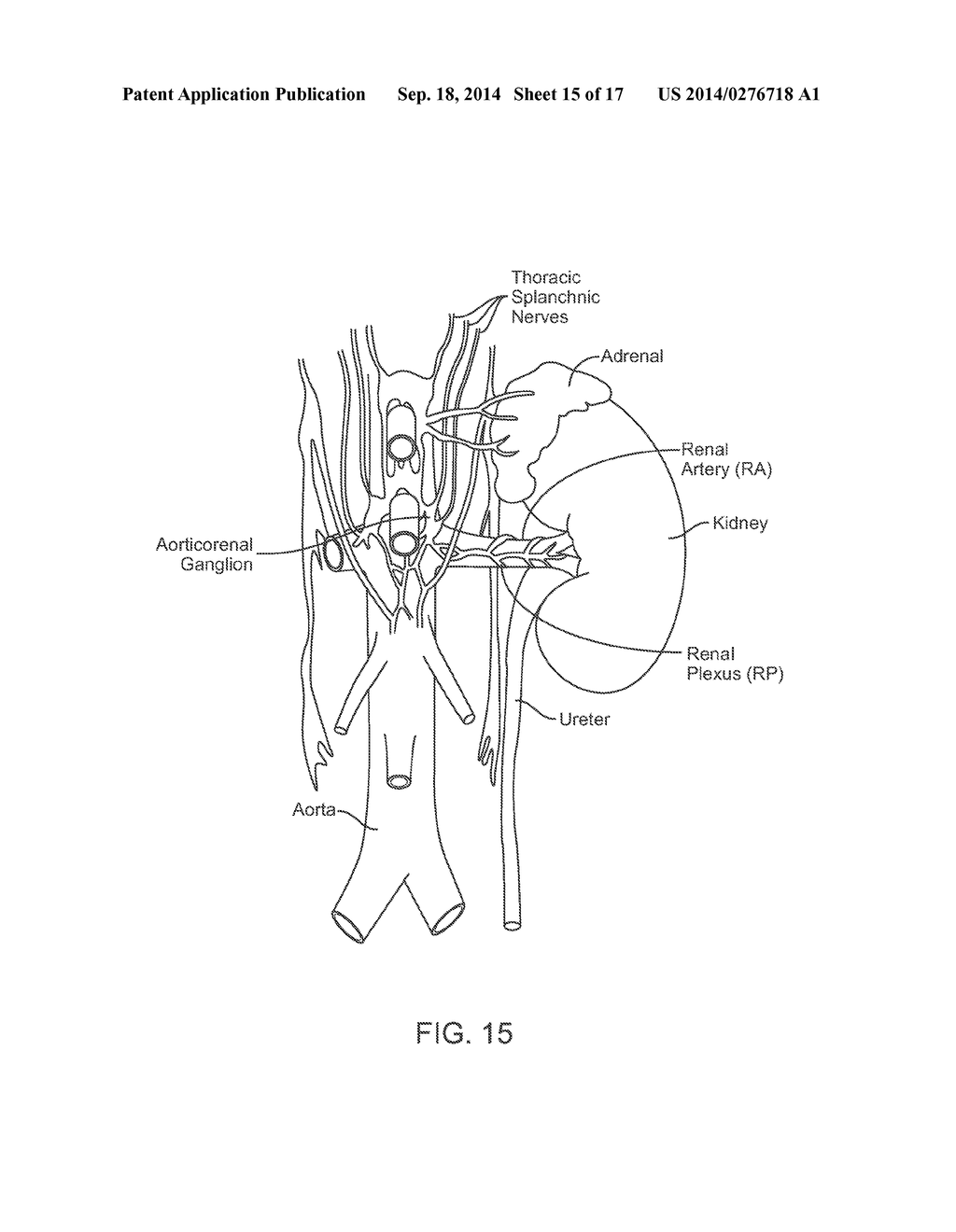 Direct Heat Ablation Catheter - diagram, schematic, and image 16