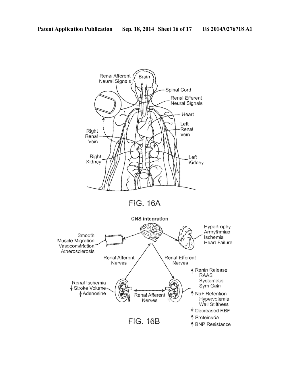 Direct Heat Ablation Catheter - diagram, schematic, and image 17