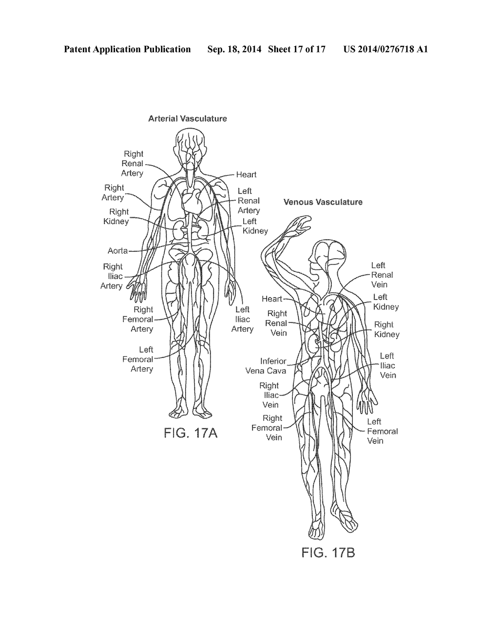 Direct Heat Ablation Catheter - diagram, schematic, and image 18