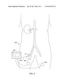 WALL-SPARING RENAL NERVE ABLATION CATHETER WITH SPACED ELECTRODE     STRUCTURES diagram and image