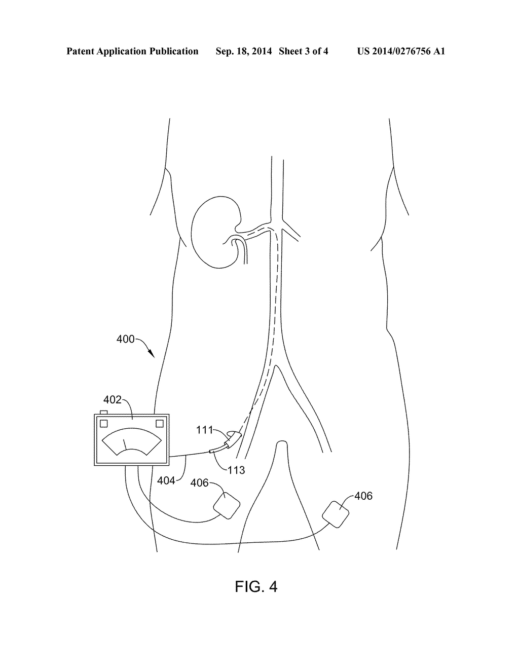 WALL-SPARING RENAL NERVE ABLATION CATHETER WITH SPACED ELECTRODE     STRUCTURES - diagram, schematic, and image 04