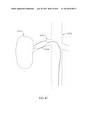 METHODS AND APPARATUSES FOR REMODELING TISSUE OF OR ADJACENT TO A BODY     PASSAGE diagram and image