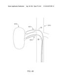 METHODS AND APPARATUSES FOR REMODELING TISSUE OF OR ADJACENT TO A BODY     PASSAGE diagram and image