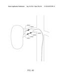 METHODS AND APPARATUSES FOR REMODELING TISSUE OF OR ADJACENT TO A BODY     PASSAGE diagram and image