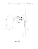 METHODS AND APPARATUSES FOR REMODELING TISSUE OF OR ADJACENT TO A BODY     PASSAGE diagram and image