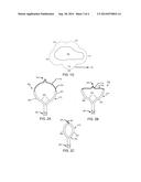 DEVICES FOR TISSUE RESECTION diagram and image