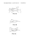 TISSUE RESECTION DEVICE AND RELATED METHODS OF USE diagram and image