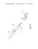 METHOD OF SURGICALLY PREPARING A PATIENT S FEMUR diagram and image