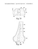 METHOD OF SURGICALLY PREPARING A PATIENT S FEMUR diagram and image