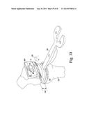 METHOD OF SURGICALLY PREPARING A PATIENT S FEMUR diagram and image