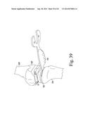 METHOD OF SURGICALLY PREPARING A PATIENT S FEMUR diagram and image