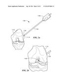 RETRO GUIDEWIRE REAMER diagram and image