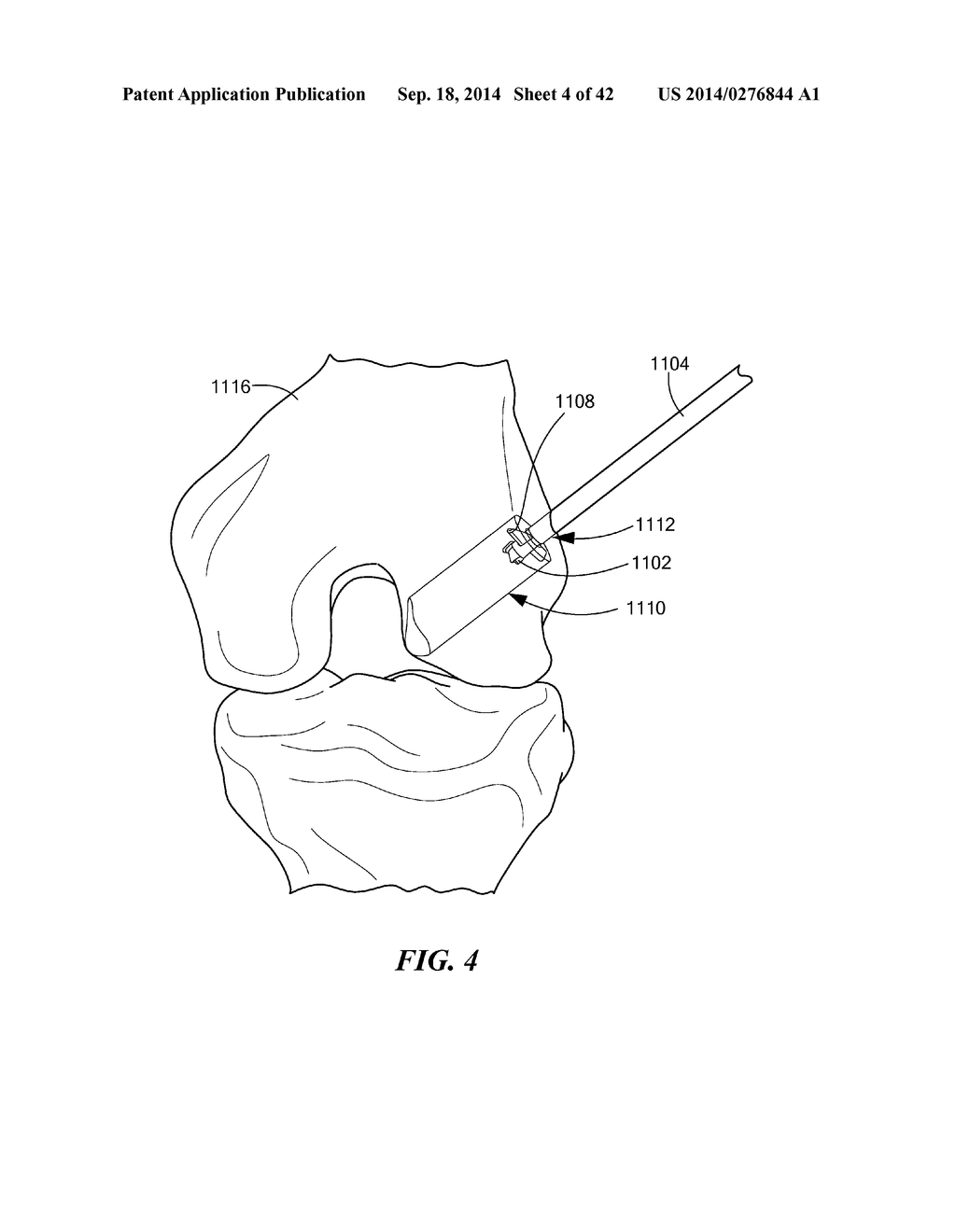 RETRO GUIDEWIRE REAMER - diagram, schematic, and image 05