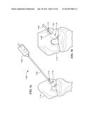 RETRO GUIDEWIRE REAMER diagram and image