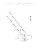 RETRO GUIDEWIRE REAMER diagram and image