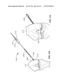 RETRO GUIDEWIRE REAMER diagram and image