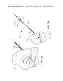 RETRO GUIDEWIRE REAMER diagram and image