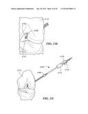 RETRO GUIDEWIRE REAMER diagram and image