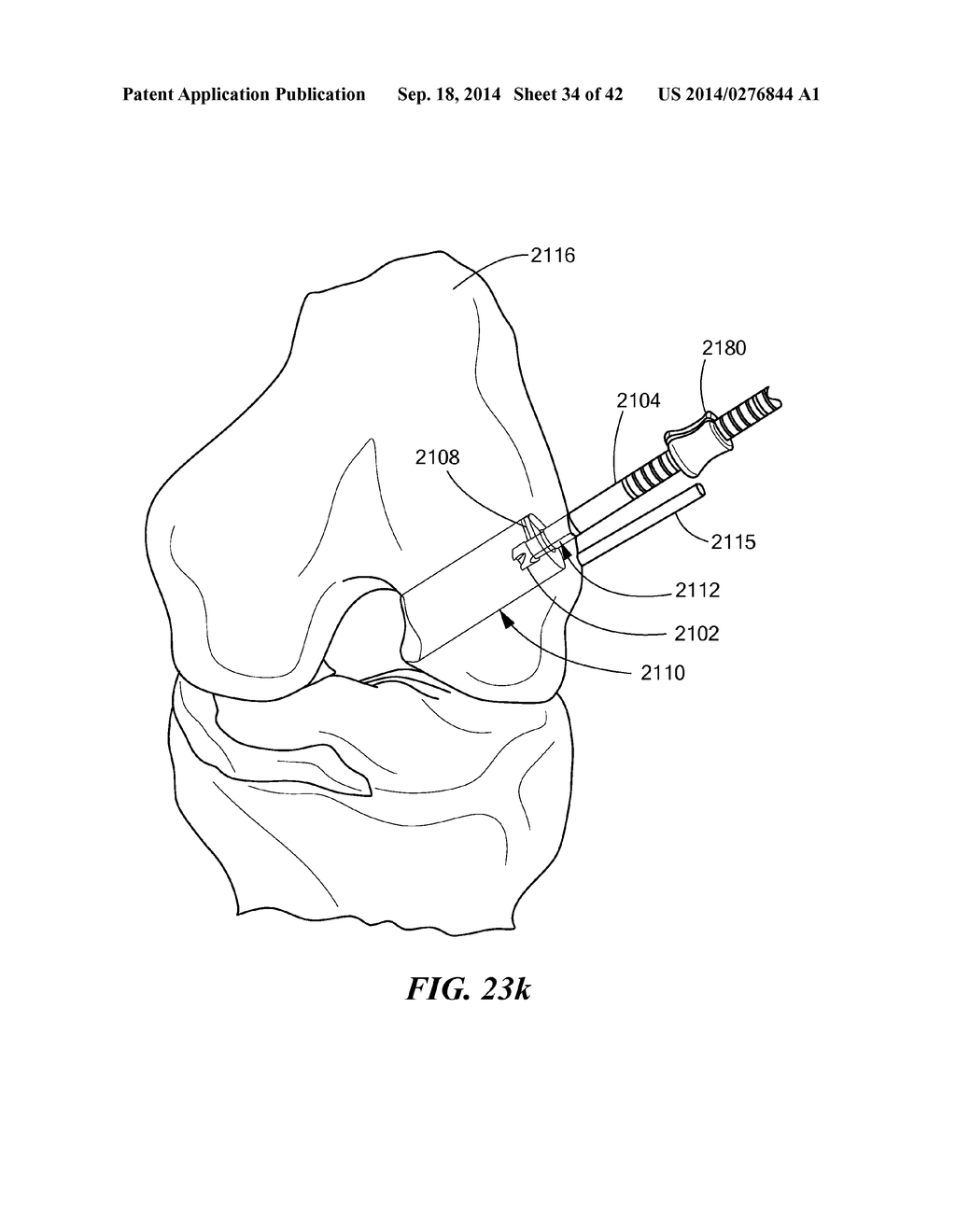 RETRO GUIDEWIRE REAMER - diagram, schematic, and image 35