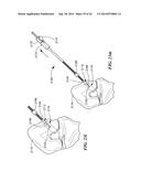 RETRO GUIDEWIRE REAMER diagram and image