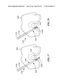 RETRO GUIDEWIRE REAMER diagram and image