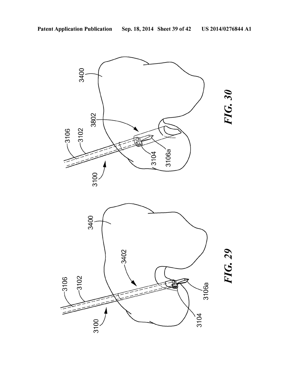 RETRO GUIDEWIRE REAMER - diagram, schematic, and image 40