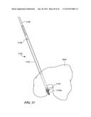 RETRO GUIDEWIRE REAMER diagram and image