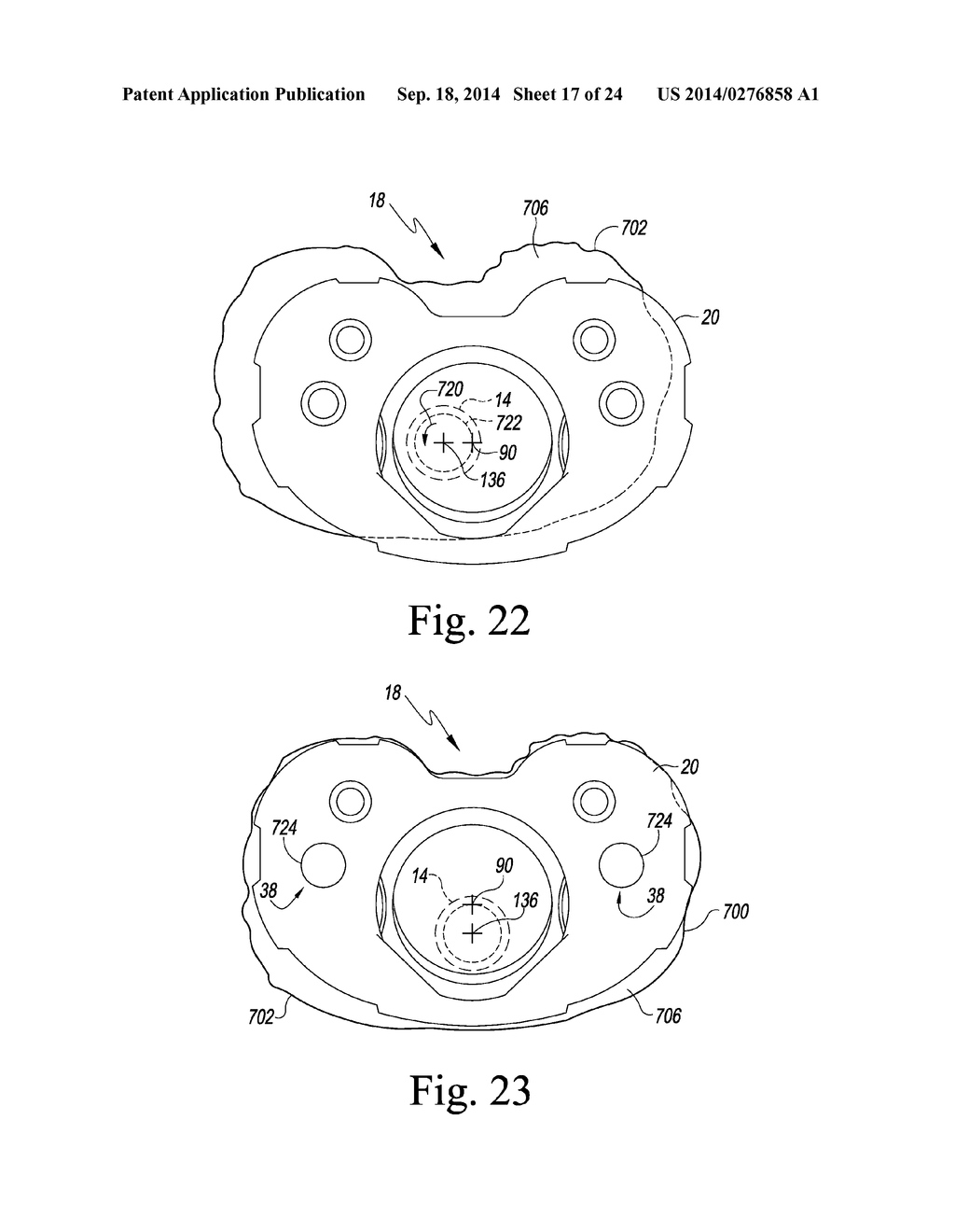 TIBIAL ORTHOPAEDIC SURGICAL INSTRUMENTS FOR SETTING OFFSET - diagram, schematic, and image 18