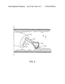 RESECTION DEVICE WITH SUPPORT MECHANISM AND RELATED METHODS OF USE diagram and image