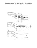 SHAPE MEMORY METAL EMBOLI TRAP diagram and image