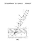 LARGE BORE CLOSURE SECONDARY HEMOSTASIS BIOADHESIVE DELIVERY SYSTEMS AND     METHODS diagram and image