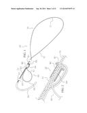 METHOD AND DEVICES FOR SECURING BIDIRECTIONAL SUTURE LOOPS USING COAXIAL     MECHANICAL FASTENERS diagram and image