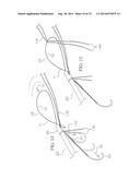 METHOD AND DEVICES FOR SECURING BIDIRECTIONAL SUTURE LOOPS USING COAXIAL     MECHANICAL FASTENERS diagram and image