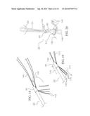 METHOD AND DEVICES FOR SECURING BIDIRECTIONAL SUTURE LOOPS USING COAXIAL     MECHANICAL FASTENERS diagram and image