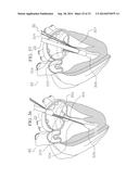 METHOD AND DEVICES FOR SECURING BIDIRECTIONAL SUTURE LOOPS USING COAXIAL     MECHANICAL FASTENERS diagram and image