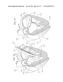 METHOD AND DEVICES FOR SECURING BIDIRECTIONAL SUTURE LOOPS USING COAXIAL     MECHANICAL FASTENERS diagram and image