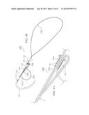 METHOD AND DEVICES FOR SECURING BIDIRECTIONAL SUTURE LOOPS USING COAXIAL     MECHANICAL FASTENERS diagram and image