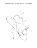 METHOD AND DEVICES FOR SECURING BIDIRECTIONAL SUTURE LOOPS USING COAXIAL     MECHANICAL FASTENERS diagram and image