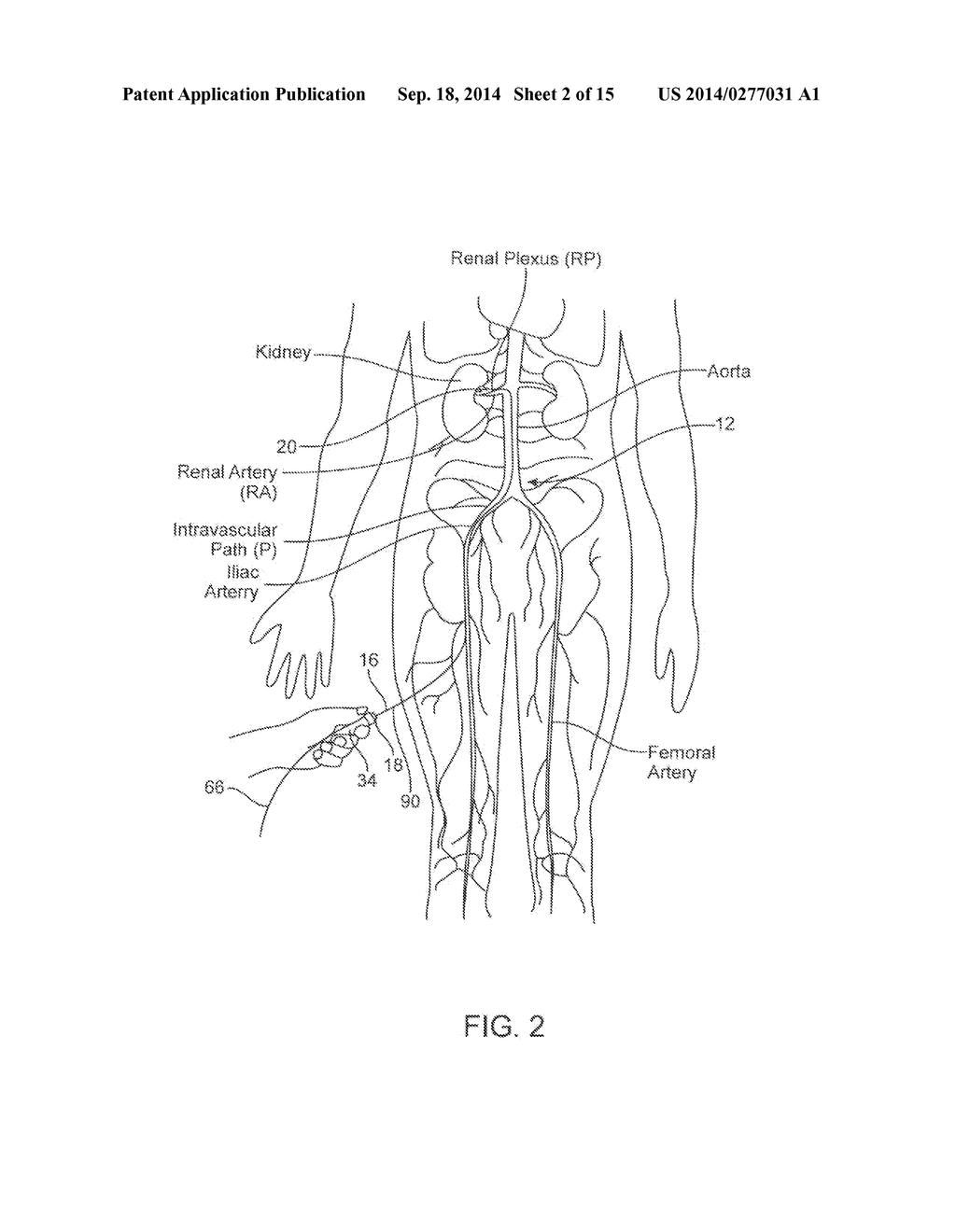 Ultrasonic Catheter for Renal Denervation - diagram, schematic, and image 03