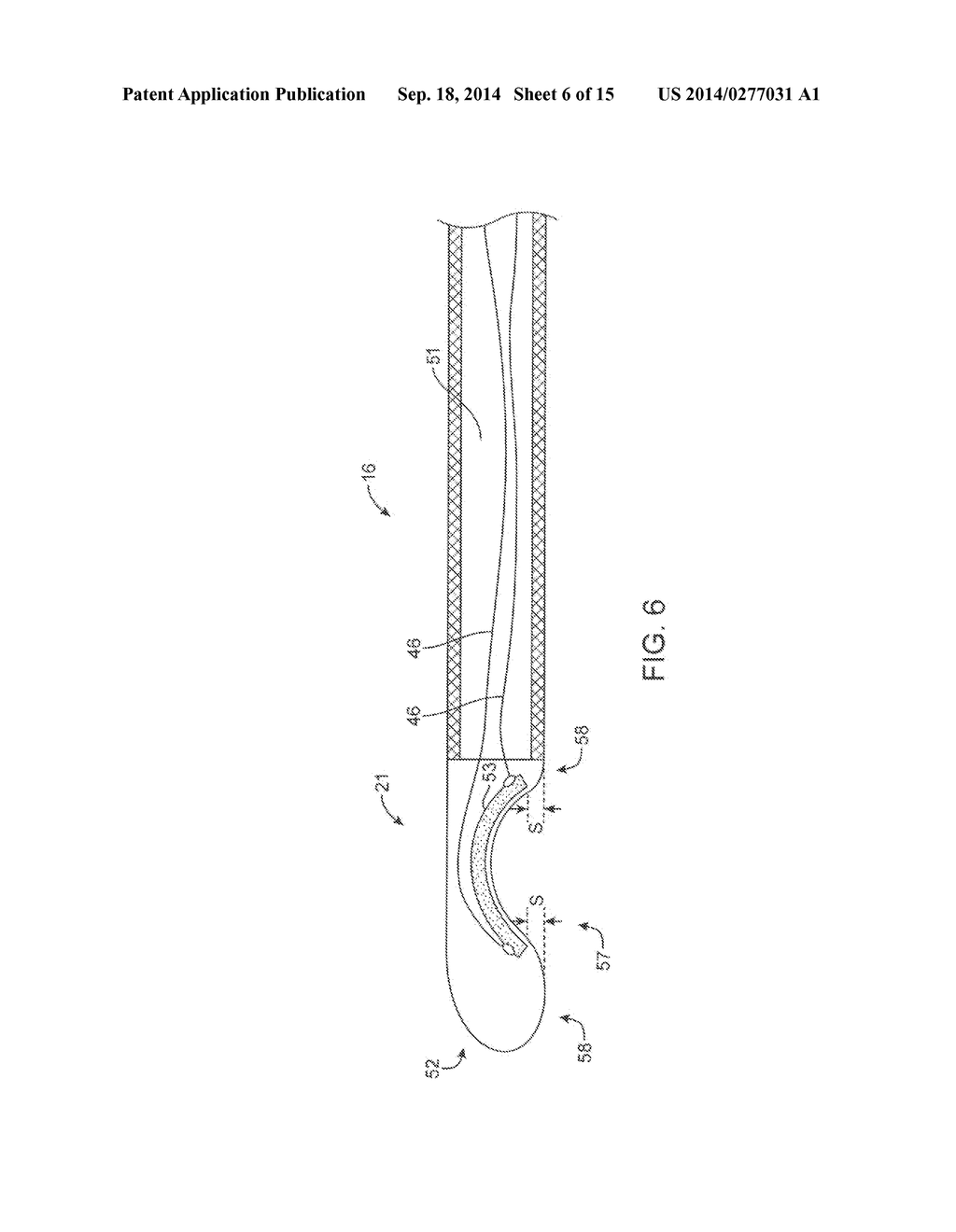 Ultrasonic Catheter for Renal Denervation - diagram, schematic, and image 07