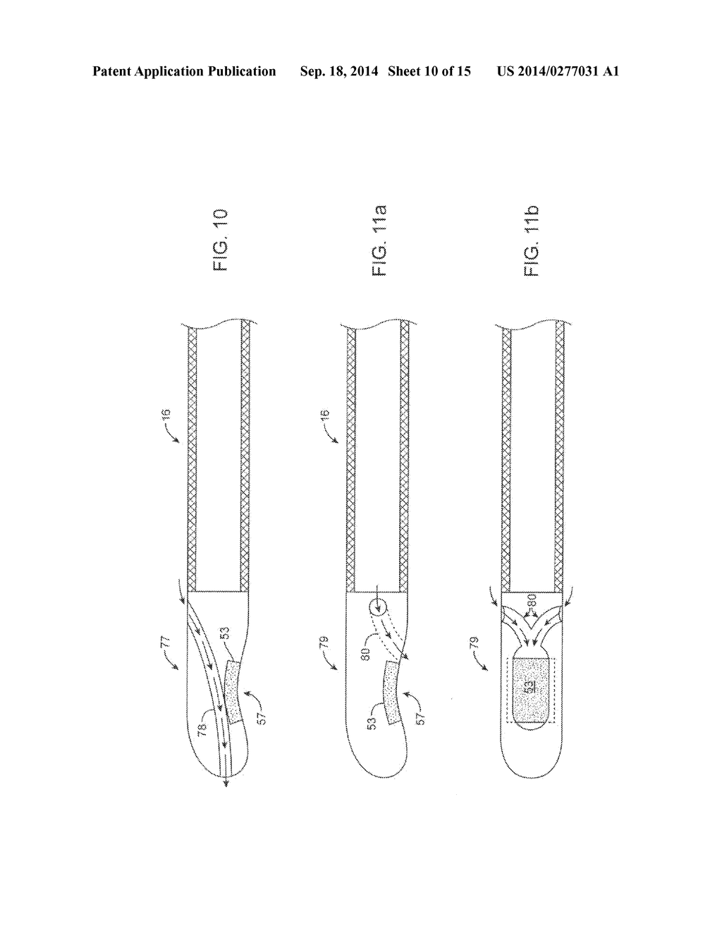 Ultrasonic Catheter for Renal Denervation - diagram, schematic, and image 11