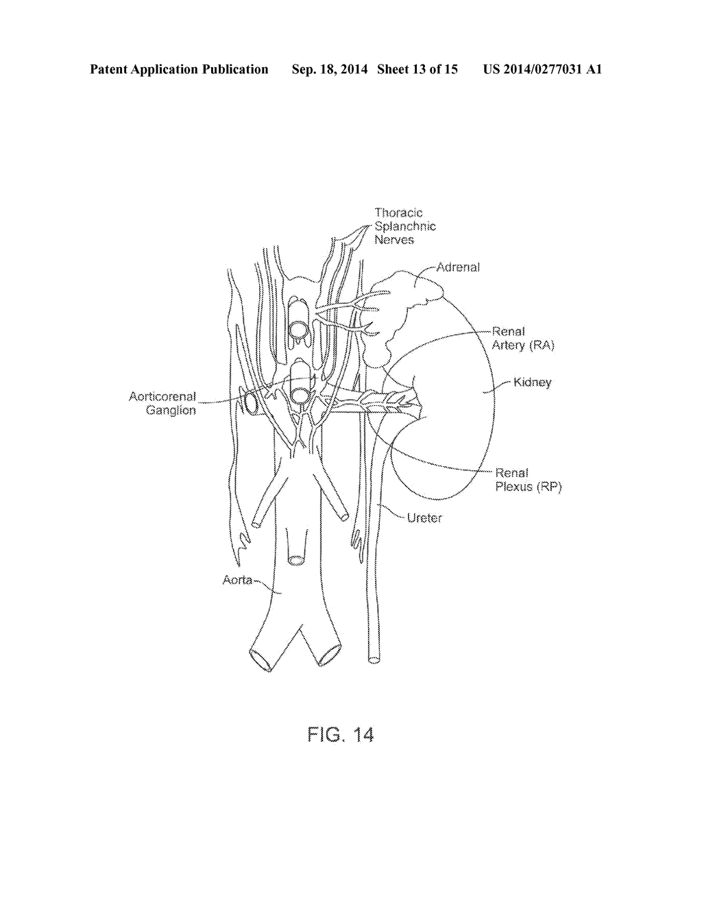 Ultrasonic Catheter for Renal Denervation - diagram, schematic, and image 14