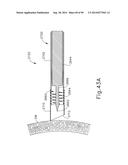 APPARATUS AND METHOD FOR TREATMENT OF ETHMOID SINUSITIS diagram and image