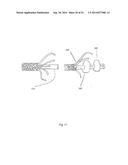 SHAPE-SET TEXTILE STRUCTURE BASED MECHANICAL THROMBECTOMY SYSTEMS diagram and image