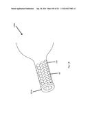 WOVEN VASCULAR DEVICE END TREATMENTS diagram and image