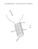 WOVEN VASCULAR DEVICE END TREATMENTS diagram and image